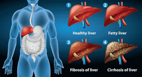 Cirrhosis of the Liver: Symptoms, Stages & Treatment